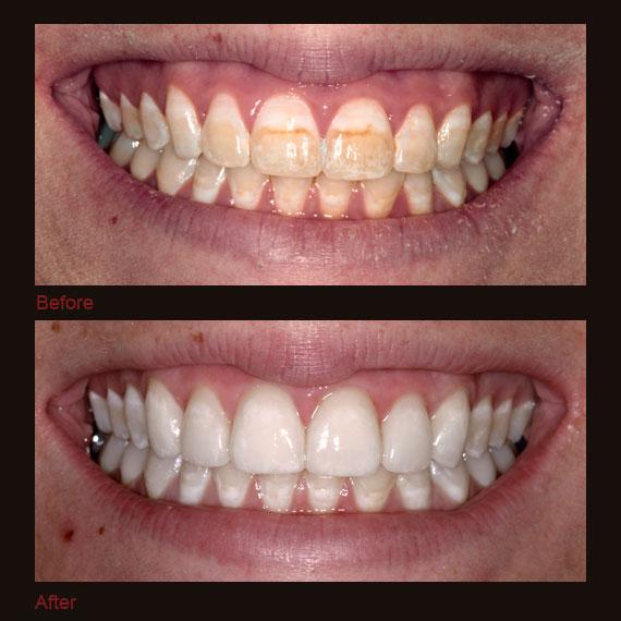 Before and after severe discoloration and full veneers